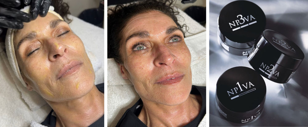japansk-bio-micro-needling-peeling-top-clinic-vejle